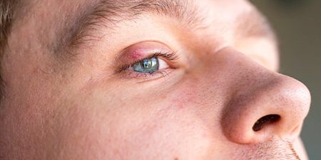 Consejos para cuidar y prevenir la aparición de los orzuelos Los orzuelos son pequeñas infecciones localizadas en el borde del párpado, similares a un grano, que pueden causar molestias o incluso dificultar la visión. Aunque en la mayoría de los casos desaparecen por sí solos, una correcta higiene ocular y algunas precauciones pueden ayudar a aliviar los síntomas y evitar su aparición recurrente. A continuación, te explicamos cómo se originan, cómo actuar si aparece uno y qué hacer para prevenirlos. ¿Qué es un orzuelo y por qué aparece? Un orzuelo es una inflamación de una glándula sebácea del párpado, provocada normalmente por la bacteria Staphylococcus aureus (estafilococo). Puede desarrollarse en la parte externa o interna del párpado, y aunque no es grave, puede resultar muy molesto. ¿Puede afectar a la visión? Sí, pero solo temporalmente. La inflamación del párpado puede dificultar la apertura completa del ojo, pero una vez disminuya, la capacidad visual no se verá afectada. ¿Es contagioso un orzuelo? El orzuelo es contagioso, especialmente si se comparte ropa de cama, toallas o se tiene contacto directo con secreciones oculares. Aunque todos podemos portar la bacteria estafilococo, no todos desarrollamos orzuelos. Aun así, conviene extremar las medidas de higiene: Lávate frecuentemente las manos. Evita compartir objetos personales. Cambia y lava con frecuencia sábanas, fundas de almohada y toallas. ¿Cuánto dura un orzuelo? La mayoría desaparecen por sí solos en 3 a 7 días, aunque algunos pueden tardar algo más. Para acelerar su curación: Aplica compresas calientes durante 10-15 minutos, 3 o 4 veces al día. Evita maquillarte o usar lentillas durante ese tiempo. No intentes explotarlo, ya que puedes agravar la infección. ¿Qué pasa si es un orzuelo interno? Un orzuelo interno se forma en el interior del párpado y puede ser más doloroso. Si no evoluciona correctamente o no drena por sí solo, es recomendable acudir a un oftalmólogo para una evaluación y tratamiento adecuado. Higiene ocular: clave para la prevención Si tienes orzuelos de forma frecuente, te recomendamos: Usar toallitas oftálmicas con tecnología de plata para una limpieza diaria de párpados, pestañas y borde palpebral. Estas toallitas eliminan impurezas y costras sin dañar ni irritar la piel. Otros síntomas asociados al orzuelo Además del bulto visible, es común experimentar: Ojo lloroso Sensibilidad a la luz Sensación de cuerpo extraño Estos síntomas suelen desaparecer junto con la inflamación del orzuelo. ¿Y si no es un orzuelo? Si el bulto persiste, no duele y es más firme, podría tratarse de un chalazión. Aunque se parece al orzuelo, el chalazión es una inflamación de una glándula sebácea más profunda y tarda más en desaparecer (puede durar semanas o incluso meses). Conclusión Los orzuelos, aunque molestos, no suelen ser graves y pueden prevenirse con una buena higiene ocular. Evitar tocarse los ojos con las manos sucias, limpiar los párpados a diario y actuar desde los primeros síntomas son claves para evitar complicaciones. En Careplus te ayudamos a cuidar tu salud ocular y a mejorar tu bienestar físico y emocional.